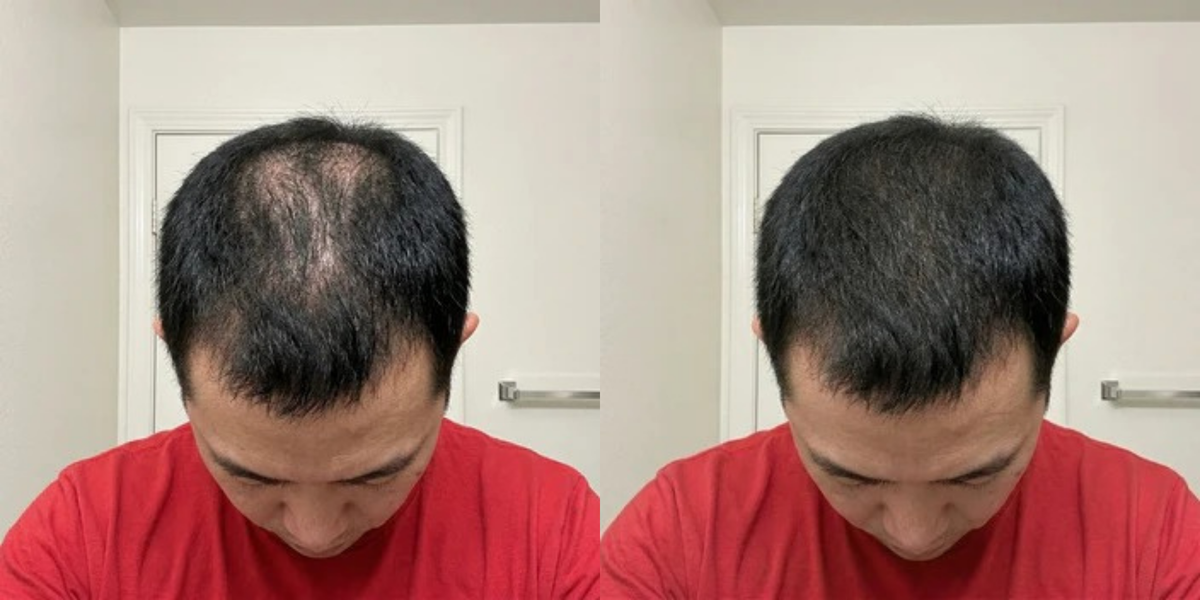 חלק קדמי וקו שיער (Hairline)
