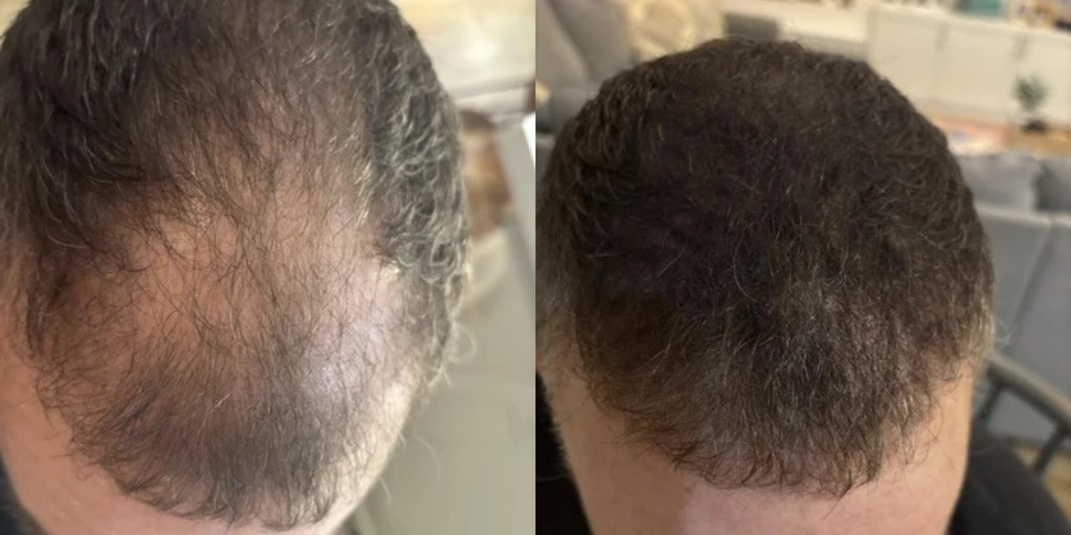 מפרצים וחלק קדמי (Hairline)